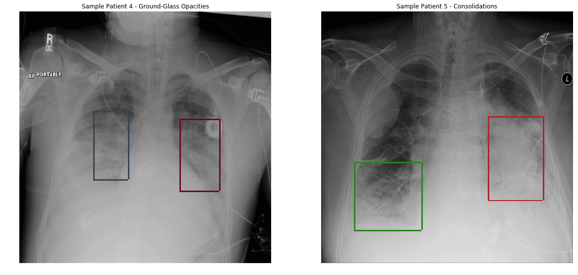 image recognition for pneumonia detection